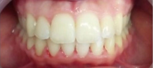 μετά την θεραπεία invisalign