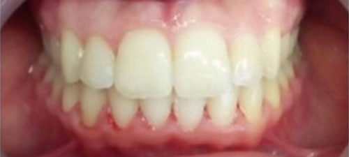 μετά την θεραπεία invisalign