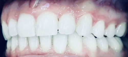 μετά την θεραπεία invisalign