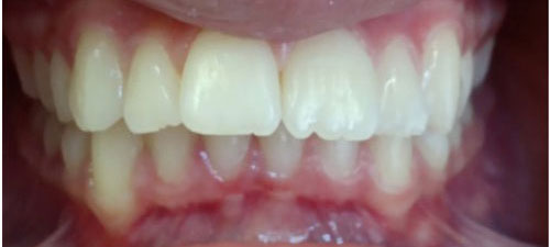 πριν την θεραπεία invisalign