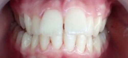 πριν την θεραπεία invisalign